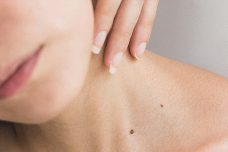 MioDottore propone cinque pratici consigli per proteggere la propria pelle